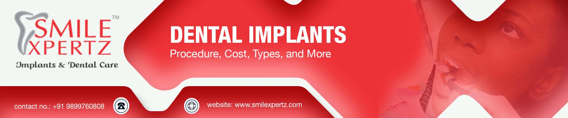 benifits dental implants