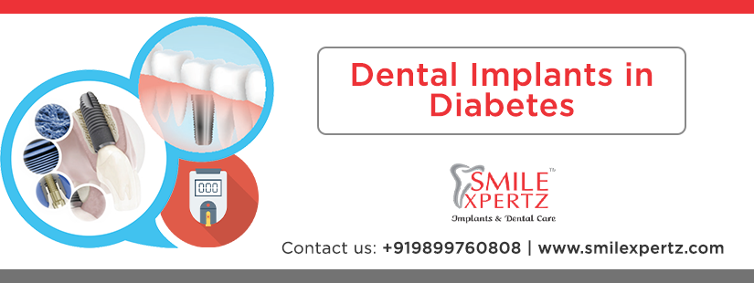 root canal treatment in gurgaon