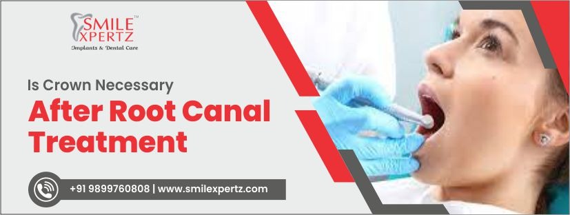 Root canal Treatment in Gurgaon