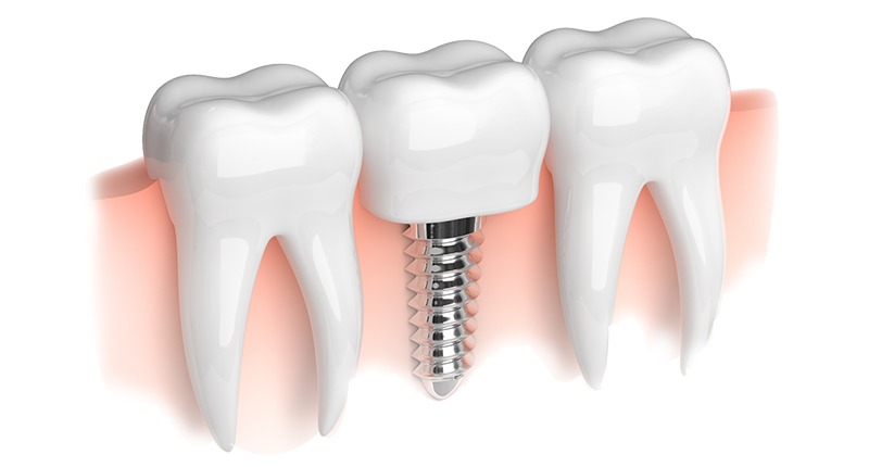 Best-Dental-Implant-Clinic-in-Gurgaon